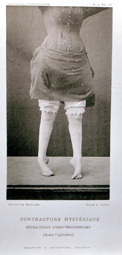 1889年にパリで出版されたジャンマルタンシャルコー教授（1825-93）による「ヌーヴェルイコノグラフィエデラサルペトリエール」の不随意拘縮 作： Albert Londe